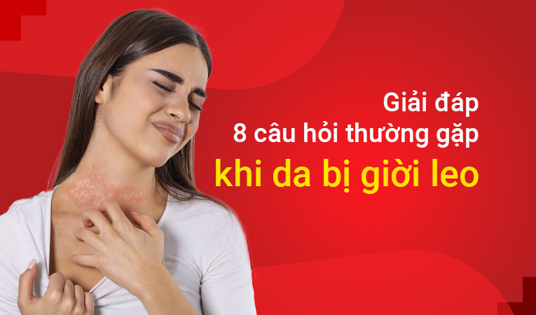 Giải đáp 8 câu hỏi thường gặp khi da bị giời leo