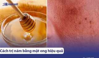 9 Cách trị nám, tàn nhang bằng mật ong tại nhà (hiệu quả rõ rệt)