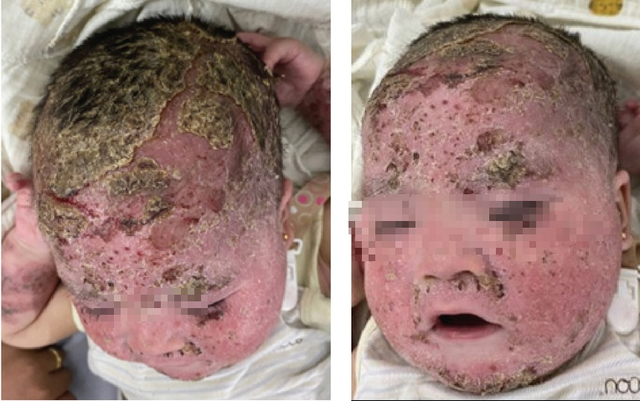 Tắm lá điều trị viêm da cơ địa, bé trai bong tróc toàn bộ da mặt và da đầu