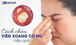 Cách chữa viêm xoang có mủ hiệu quả