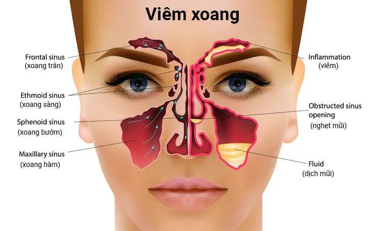 Nhận biết triệu chứng của các loại viêm xoang để điều trị đúng cách