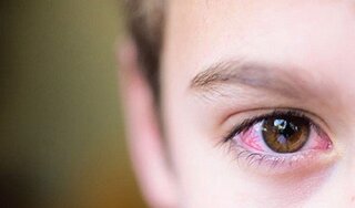 Số trẻ em bị đau mắt đỏ tăng mạnh, TP.HCM truy tìm nguyên nhân