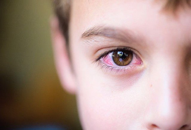 ố trẻ em bị đau mắt đỏ tăng mạnh, TP.HCM truy tìm nguyên nhân