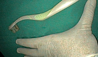 Nữ sinh ở Thanh Hóa nuốt bàn chải đánh răng 20 cm vào bụng 