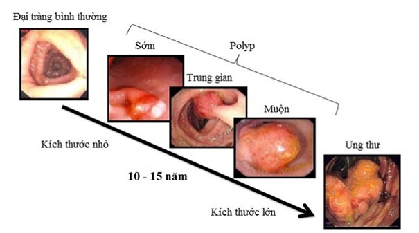 Viêm đại tràng có chuyển thành ung thư không?