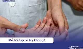 Bệnh đổ mồ hôi tay chân có lây không?