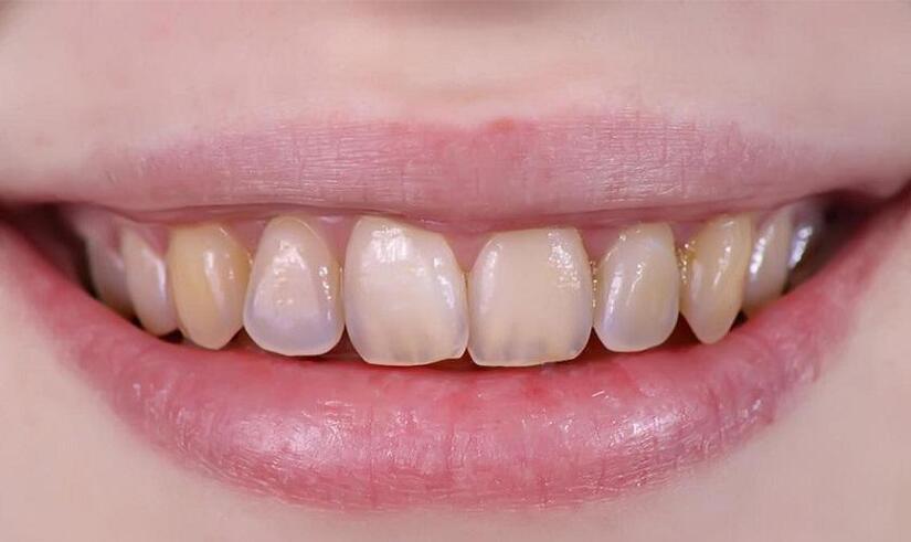 Tẩy trắng răng - Bí quyết sở hữu hàm răng trắng sáng chỉ sau 30 phút