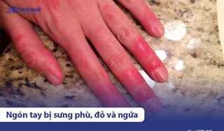 Ngón tay bị sưng phù, mẩn đỏ và ngứa là bệnh gì? Xử lý thế nào?