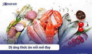 4 dấu hiệu của dị ứng thức ăn & cách trị hiệu quả, nhanh chóng