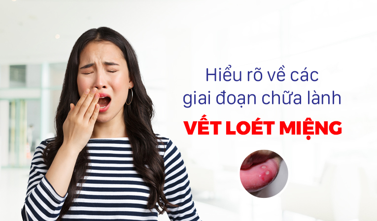 Hiểu rõ về các giai đoạn chữa lành vết loét miệng