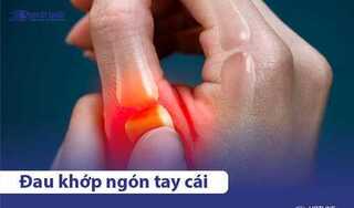 Đau khớp ngón tay cái là bệnh gì? Phải làm sao để điều trị?
