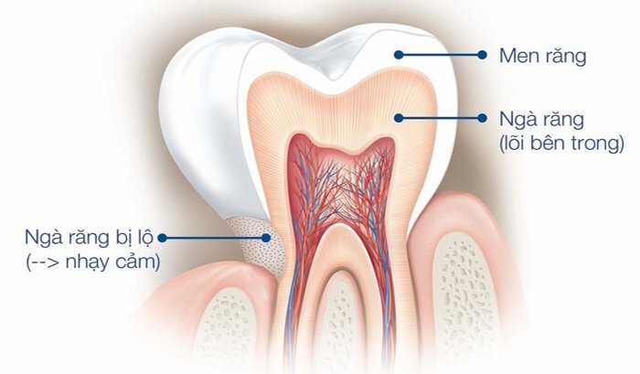 Ê buốt răng khi ăn uống: Phải làm sao?