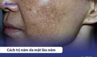 12+ cách trị nám da mặt lâu năm hiệu quả, không tái phát