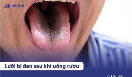 Vì sao lưỡi bị đen sau khi uống rượu? Có nguy hiểm không?