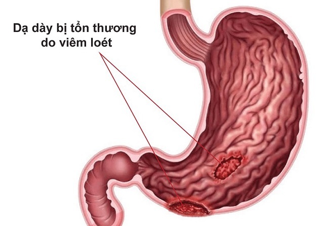 Phân tích rõ nguyên nhân gây đau dạ dày về đêm