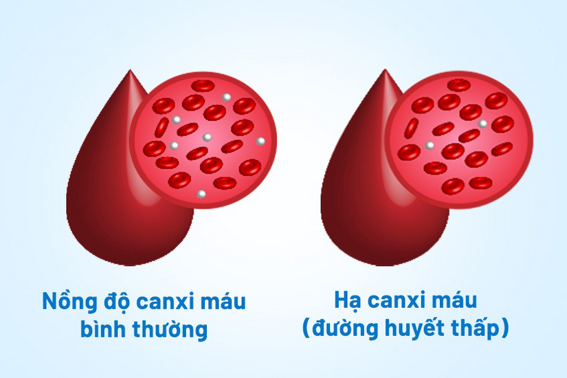 Nên bổ sung canxi cho người bị hạ canxi máu như thế nào?