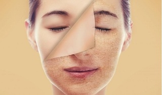 Tại sao da mặt căng rát vào mùa đông và cách khắc phục?