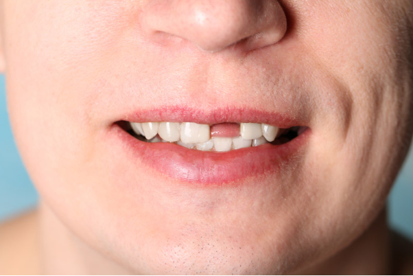 Giá trồng răng cửa bao nhiêu? Trồng răng cửa ở đâu chi phí hợp lý?