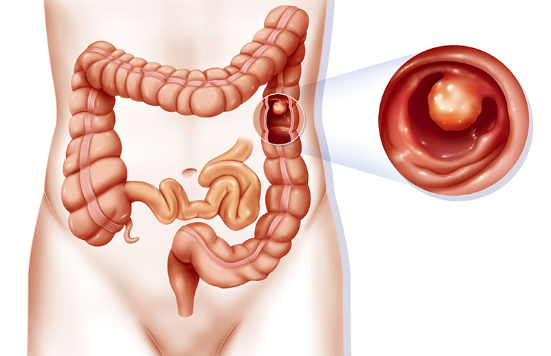 Viêm loét đại trực tràng: Nguyên nhân và phương pháp điều trị