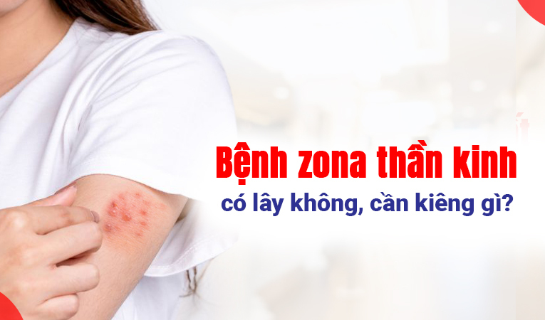 Bệnh zona thần kinh có lây không, cần kiêng gì?