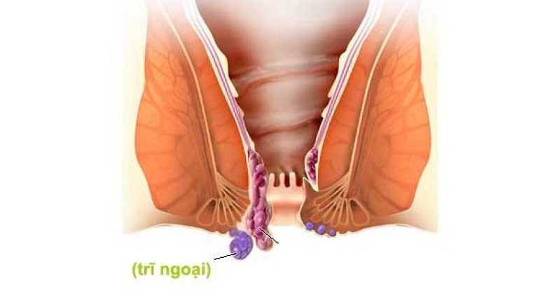 Tuýp gel bôi trĩ là gì? Dùng như thế nào cho hiệu quả?