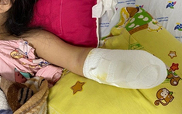 Bé gái 5 tuổi ở TP.HCM mất bàn tay bởi pháo nhà hàng xóm 