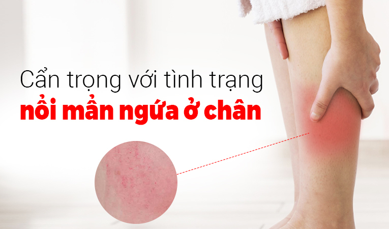 Cẩn trọng với tình trạng nổi mẩn ngứa ở chân