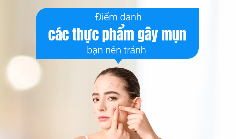 Điểm danh các thực phẩm gây mụn bạn nên tránh