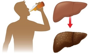 Cảnh báo những biến chứng nguy hiểm của viêm gan do rượu