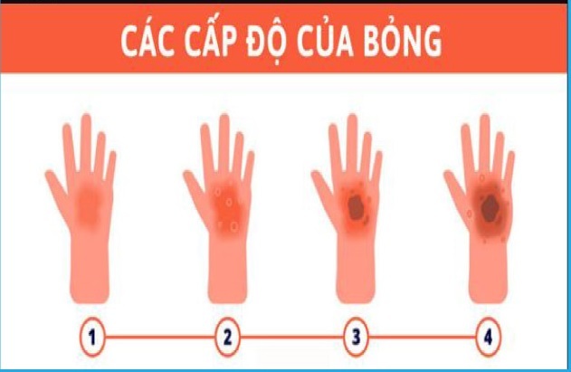 Cần làm gì khi vết bỏng bị phồng nước?