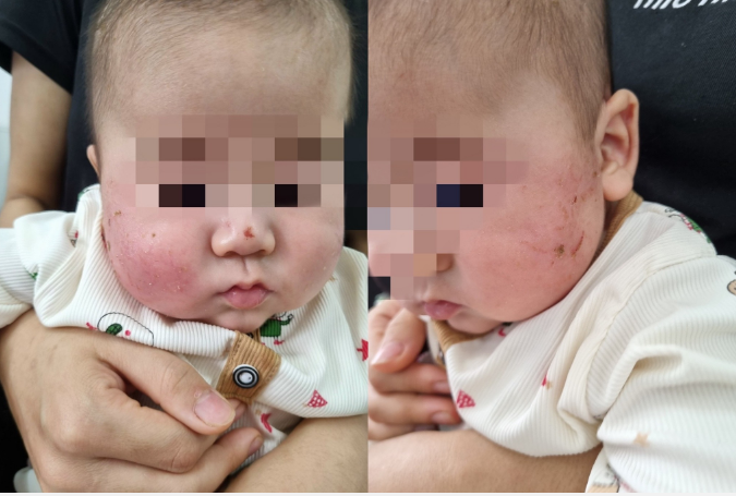 Tự đắp lá cây chữa viêm da tại nhà, bé 4 tháng tuổi bị loét nặng 2 má