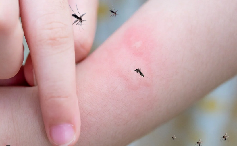 Bị muỗi đốt ngứa nhiều ngày: Đã có cách hay!