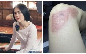 Ngọc Trinh tiết lộ tình trạng vết thương sau 5 tháng gặp tai nạn lái xe mô tô