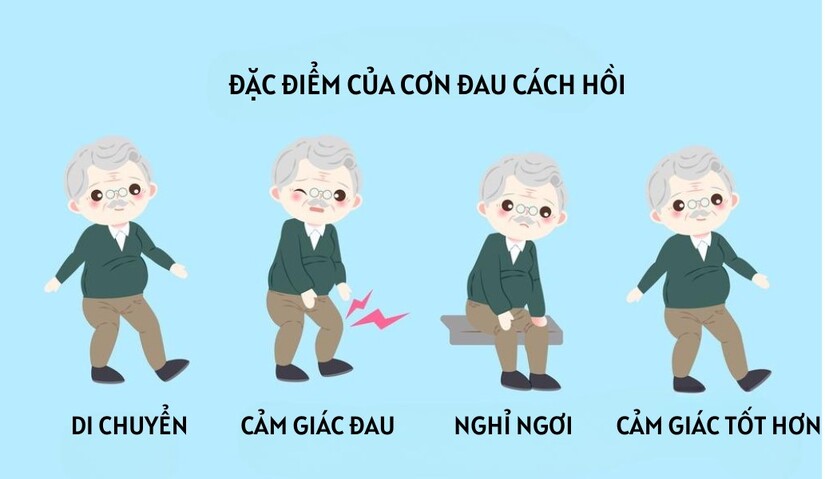 Đau cách hồi: Dấu hiệu cảnh báo nguy hiểm!