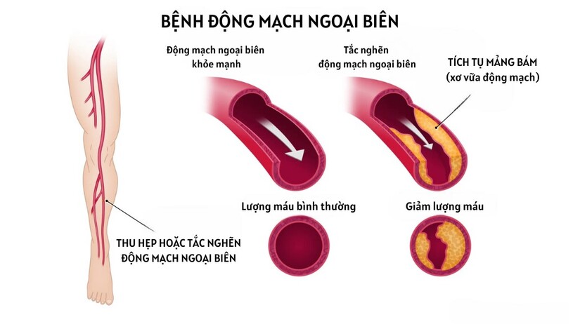 Đau cách hồi: Dấu hiệu cảnh báo nguy hiểm!