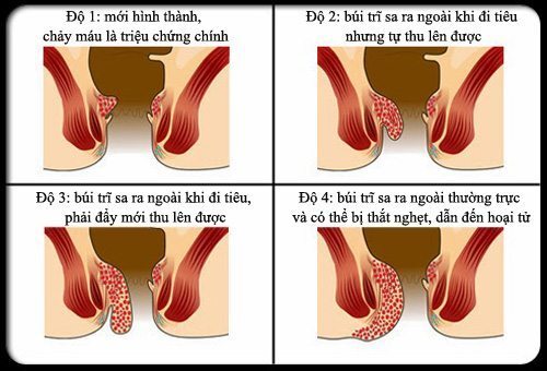 Đặc điểm búi trĩ nội và các biện pháp điều trị hiệu quả