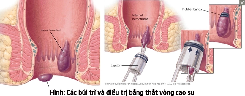 Đặc điểm búi trĩ nội và các biện pháp điều trị hiệu quả