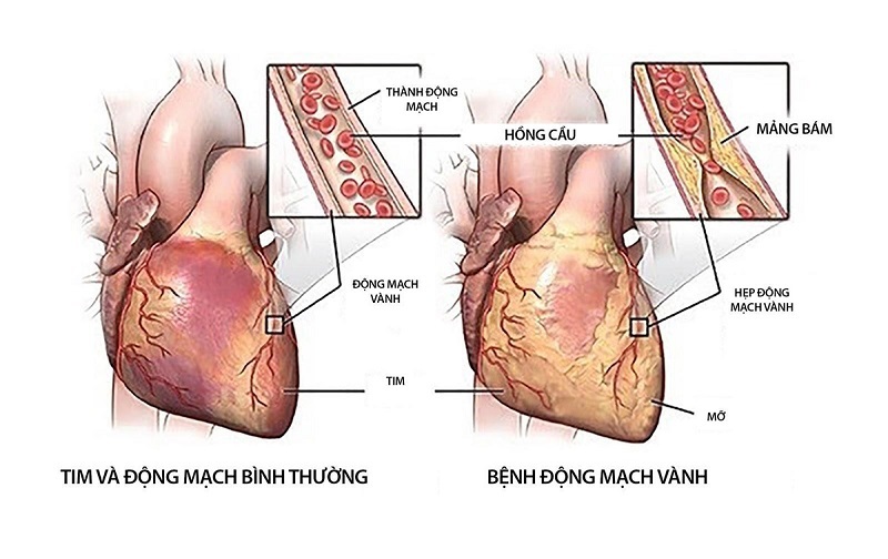 Bệnh động mạch vành và các nguy cơ biến chứng tim mạch nguy hiểm