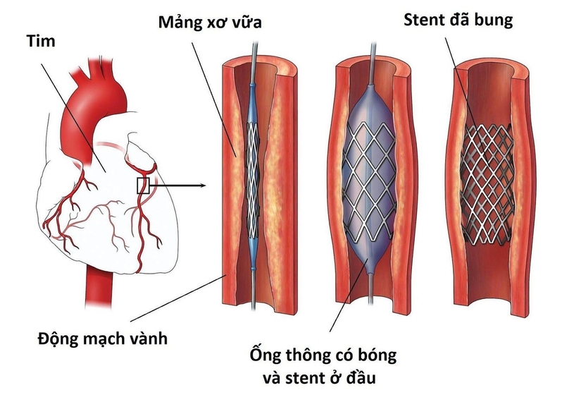 Bệnh động mạch vành và các nguy cơ biến chứng tim mạch nguy hiểm