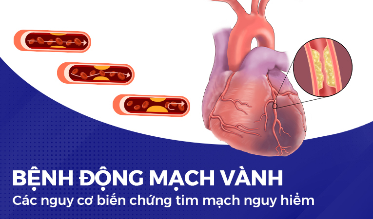 Bệnh động mạch vành và các nguy cơ biến chứng tim mạch nguy hiểm