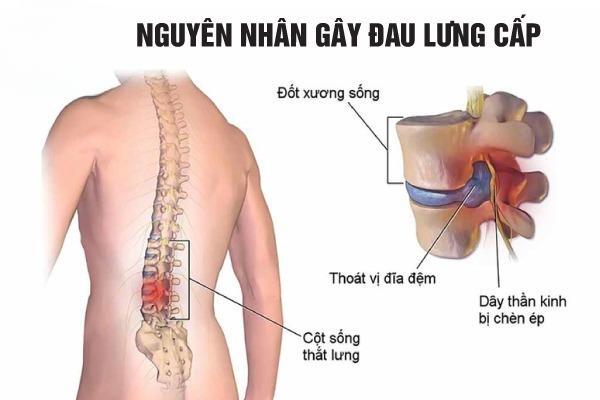 Bệnh đau lưng cấp: Làm sao để giảm nhanh cơn đau dữ dội?