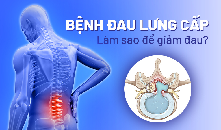 Bệnh đau lưng cấp: Làm sao để giảm nhanh cơn đau dữ dội?