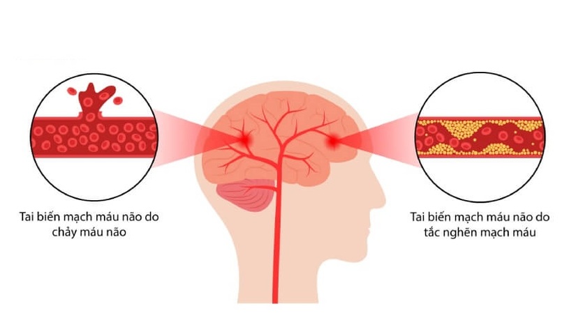 Hiểu rõ về 2 loại tai biến mạch máu não để điều trị đúng cách!