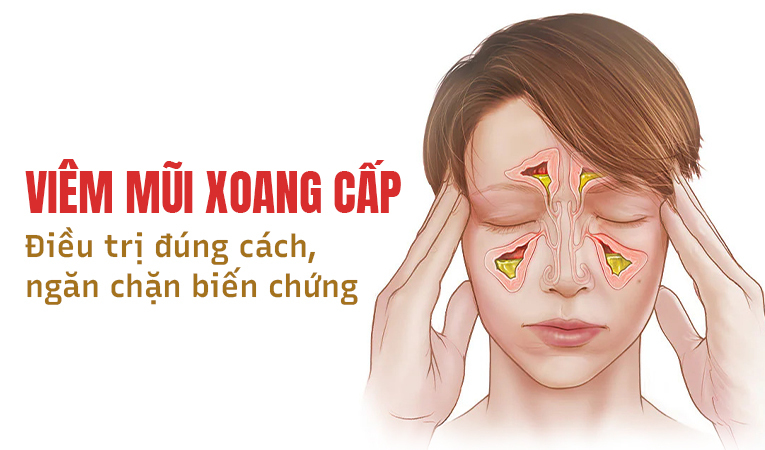 Viêm mũi xoang cấp: Điều trị đúng cách, ngăn chặn biến chứng