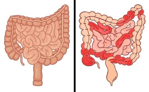 Nguyên nhân và dấu hiệu cảnh báo đường ruột “bẩn”