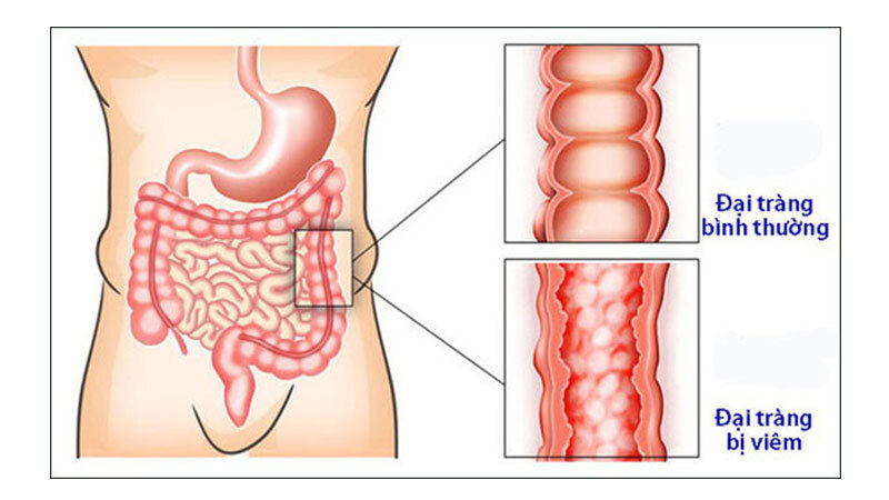 Viêm đại tràng nên ăn gì? Chế độ ăn tốt cho người mắc bệnh đại tràng