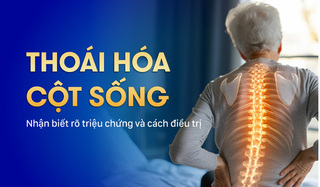 Thoái hóa cột sống: Nhận biết rõ triệu chứng và cách điều trị