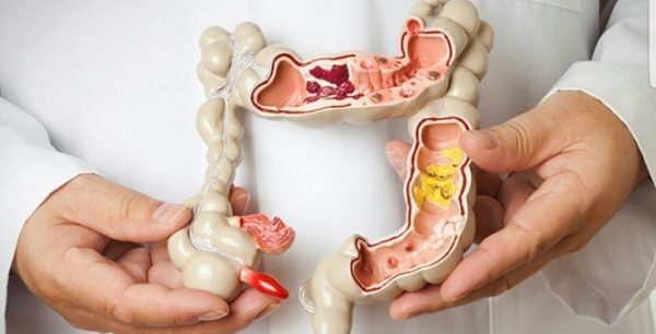 Giảm táo bón hiệu quả: Nên bổ sung men vi sinh ngay!