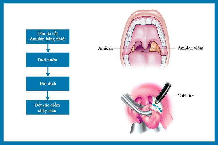 Khi nào thì cần cắt amidan? Cách phương pháp cắt bỏ amidan hiện nay