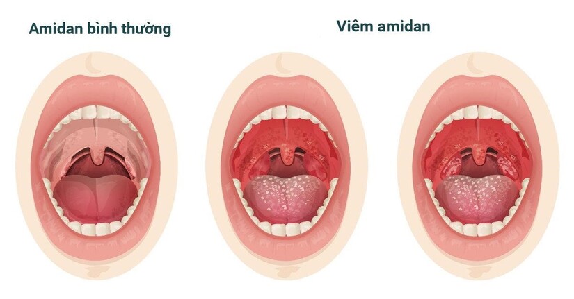 Khi nào thì cần cắt amidan? Cách phương pháp cắt bỏ amidan hiện nay